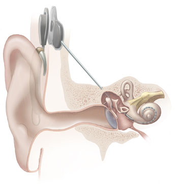 HDA2014_Nadbrahm2_Cochlear_implant.jpg